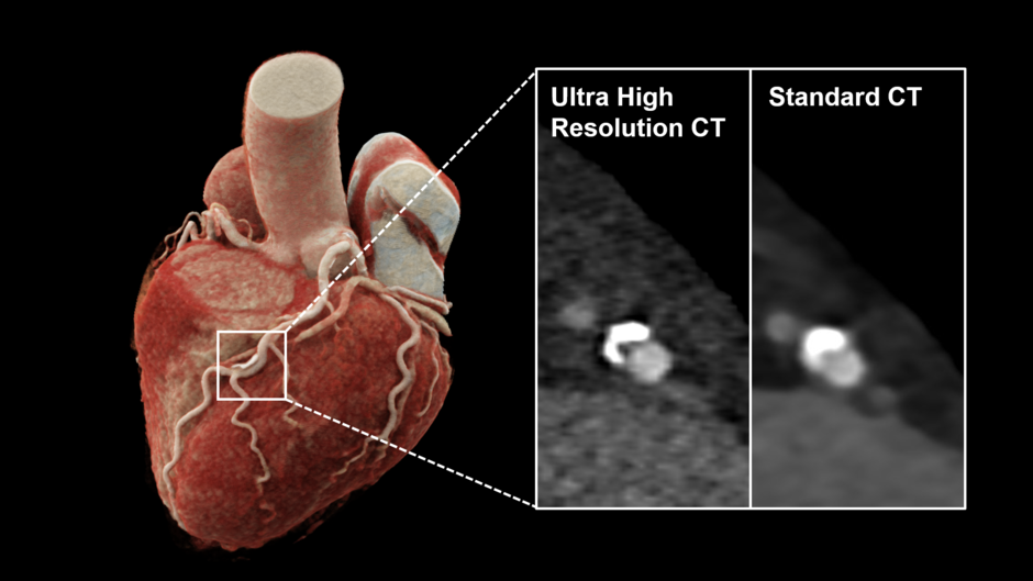 Innovative Computertomographie verbessert Beurteilung der koronaren Herzkrankheit