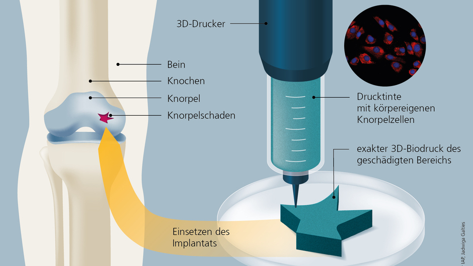 Verstärkung fürs Knie: 3D-Biodruck mit körpereigenen Knorpelzellen