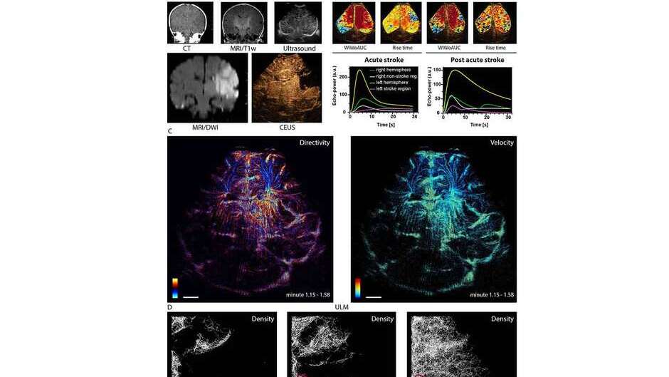 Neue Ultraschall-Methode gewährt detaillierte Einblicke ins Gehirn von Neugeborenen